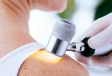 Melanoma